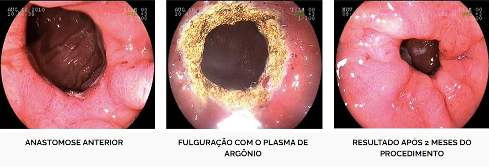 Plasma Argonio